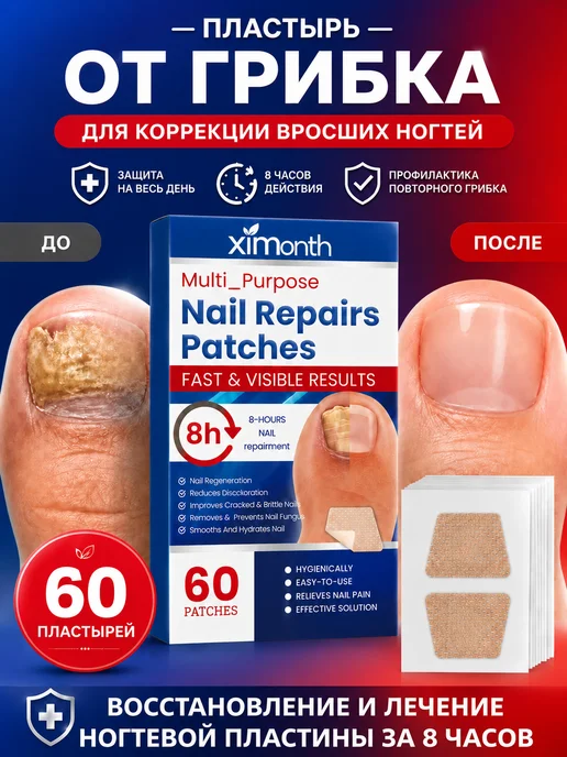 XIMonth Пластырь от грибка для коррекции вросших ногтей, 60 шт