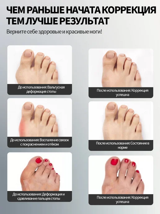 Ночной бандаж-корректор от косточки на ноге, белый, фото 5