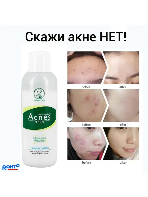 Матирующий лосьон от акне MENTHOLATUM ACNES 150мл, 150 мл, фото 6