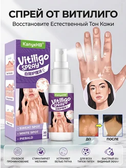 Спрей от витилиго и пигментации кожи, 30 мл