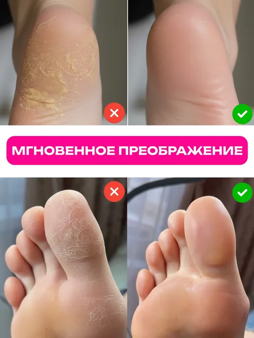 Жидкое лезвие кератолитик и терка для пяток профессиональная, 400 мл, фото 4